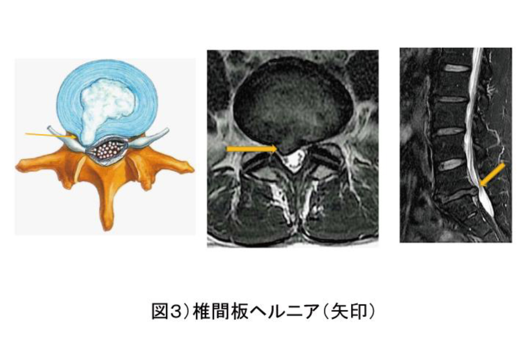 腰椎椎間板ヘルニア