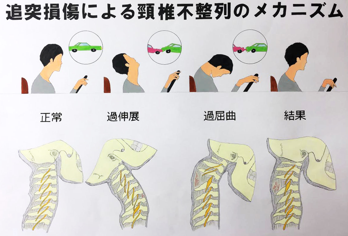 追突損傷による頸椎不整列のメカニズム